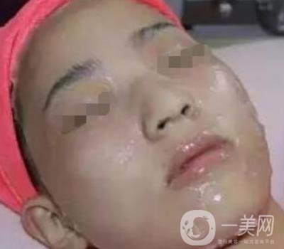 湖南省人民醫(yī)院點陣激光祛斑價格表及案例分享