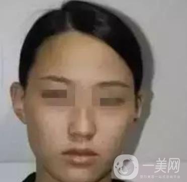 湖南省人民醫(yī)院點陣激光祛斑價格表及案例分享