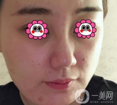 鼓樓醫(yī)院可以打*嗎?附案例恢復(fù)圖及整形價(jià)格表