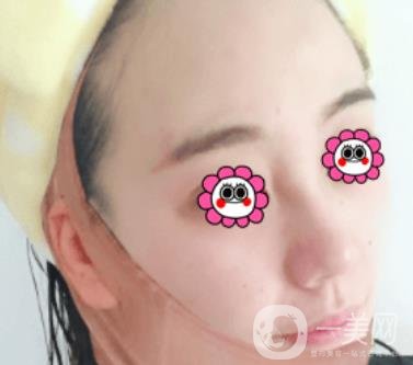 鼓樓醫(yī)院可以打*嗎?附案例恢復(fù)圖及整形價(jià)格表