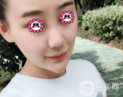 鼓樓醫(yī)院可以打*嗎?附案例恢復(fù)圖及整形價(jià)格表