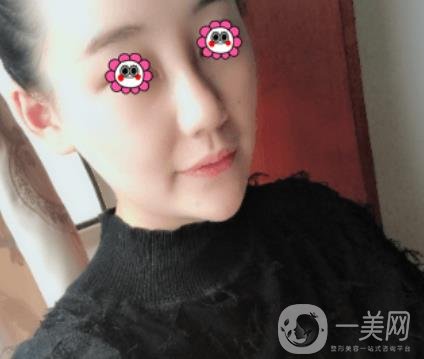 鼓樓醫(yī)院可以打*嗎?附案例恢復(fù)圖及整形價(jià)格表