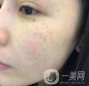 蘇州附一醫(yī)院可以激光祛斑嗎?案例圖及整形價(jià)格表分享