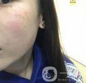 蘇州附一醫(yī)院可以激光祛斑嗎?案例圖及整形價(jià)格表分享