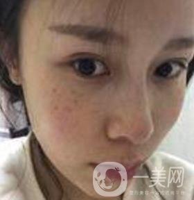 蘇州附一醫(yī)院可以激光祛斑嗎?案例圖及整形價(jià)格表分享