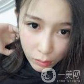 蘇州附一醫(yī)院可以激光祛斑嗎?案例圖及整形價(jià)格表分享