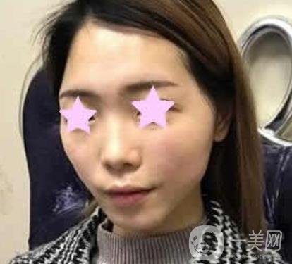 北大醫(yī)院脂肪填充