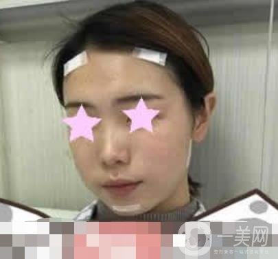 北大醫(yī)院脂肪填充