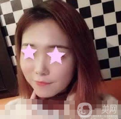 北大醫(yī)院脂肪填充