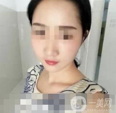 河南省人民醫(yī)院脂肪填充