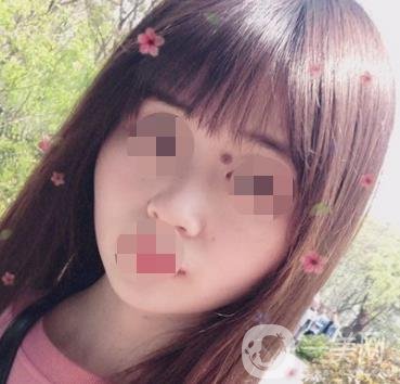 贛州附屬醫(yī)院整形美容科價格表及點(diǎn)痣案例公布，速覽