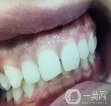 龍崗中心醫(yī)院整牙多少錢？價格表2020收費明細(xì)公開一覽