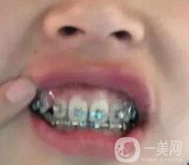 龍崗中心醫(yī)院整牙多少錢？價格表2020收費明細(xì)公開一覽