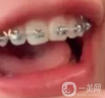 龍崗中心醫(yī)院整牙多少錢？價格表2020收費明細(xì)公開一覽