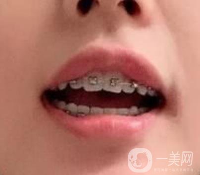 龍崗中心醫(yī)院整牙多少錢？價格表2020收費明細(xì)公開一覽