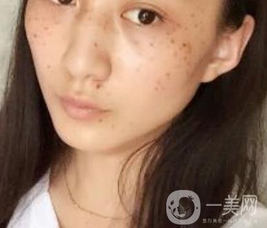 安醫(yī)一附院整形外科價(jià)格表2020版，還有激光祛斑案例