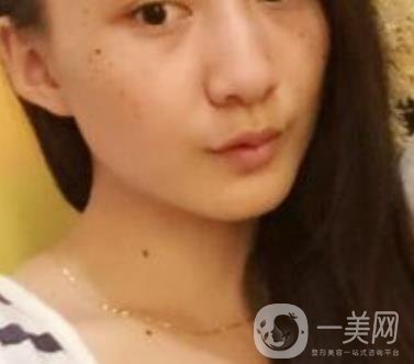 安醫(yī)一附院整形外科價(jià)格表2020版，還有激光祛斑案例