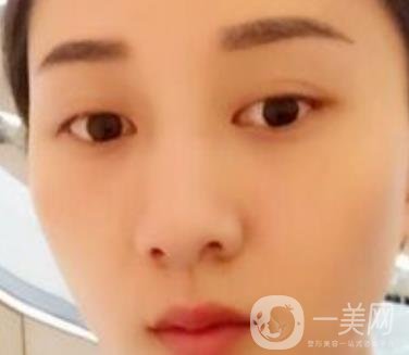 安醫(yī)一附院整形外科價(jià)格表2020版，還有激光祛斑案例