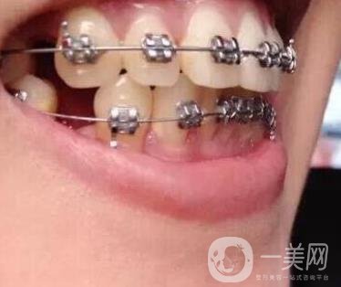 北京市海淀醫(yī)院口腔科價格表2020更新，附牙齒矯正案例