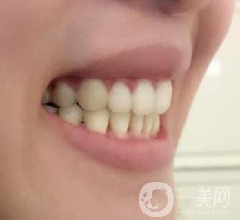 北京市海淀醫(yī)院口腔科價格表2020更新，附牙齒矯正案例