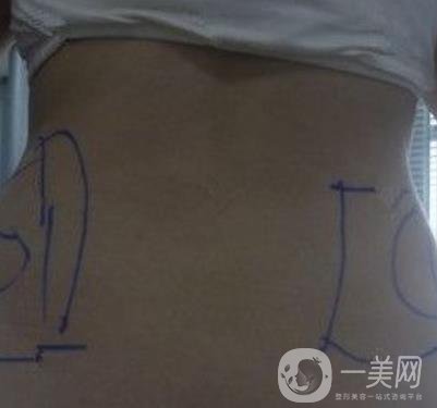 襄陽市第一人民醫(yī)院整形美容科吸脂瘦肚子多少錢？價(jià)格表整形日記一覽
