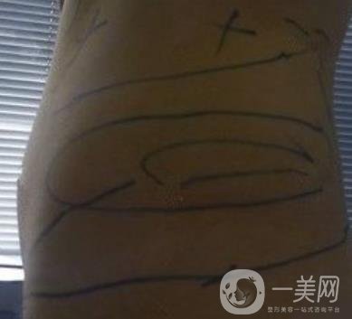 襄陽市第一人民醫(yī)院整形美容科吸脂瘦肚子多少錢？價(jià)格表整形日記一覽