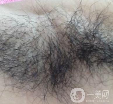 山東省立醫(yī)院整形科激光脫毛*果好嗎?價(jià)格收費(fèi)標(biāo)準(zhǔn)表一覽