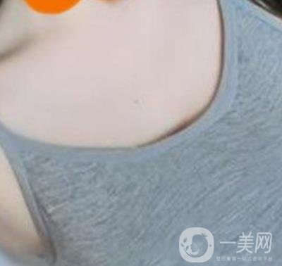 廣州南方醫(yī)院美容科怎么樣?附2020全新價格表及隆胸案例