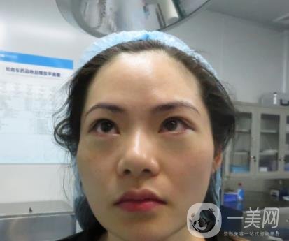 廣州南方醫(yī)院去眼袋費用多少?2020整形價格表一覽