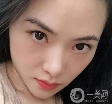 廣州南方醫(yī)院去眼袋費用多少?2020整形價格表一覽