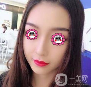 沈陽(yáng)杏林崔昌墉做鼻子怎么樣?2020整形價(jià)格表一覽