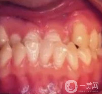 鄭大一附院口腔正畸怎么樣?附項(xiàng)目?jī)r(jià)格表及案例圖