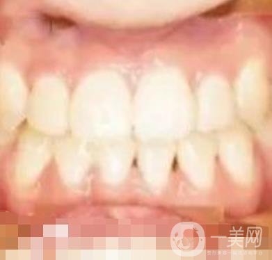 鄭大一附院口腔正畸怎么樣?附項(xiàng)目?jī)r(jià)格表及案例圖