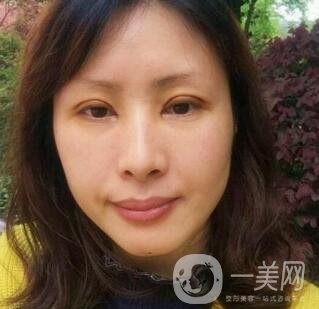 沈陽(yáng)軍區(qū)總醫(yī)院整形外科價(jià)格表，附雙眼皮真實(shí)案例