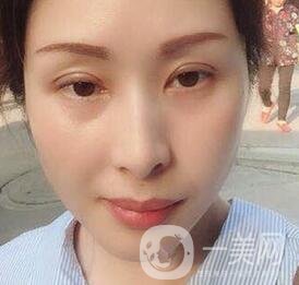 沈陽(yáng)軍區(qū)總醫(yī)院整形外科價(jià)格表，附雙眼皮真實(shí)案例