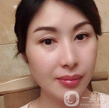 沈陽(yáng)軍區(qū)總醫(yī)院整形外科價(jià)格表，附雙眼皮真實(shí)案例