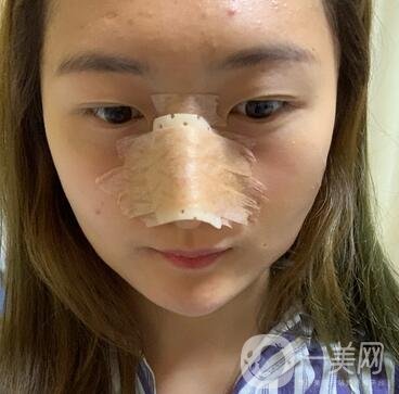 重慶新橋醫(yī)院整形科價格表，隆鼻案例分享