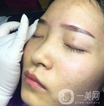北京朝陽醫(yī)院整形中心紋眉*果怎么樣？價格價目表詳情一覽