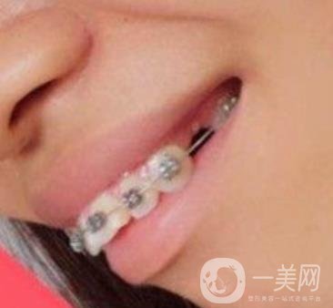 復(fù)旦大學(xué)附屬兒科醫(yī)院口腔科做牙齒矯正多少錢(qián)？?jī)r(jià)格表明細(xì)一覽