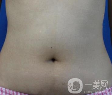 哈爾濱醫(yī)科大學(xué)附屬第一醫(yī)院整形科價格表和吸脂瘦肚子全新公布