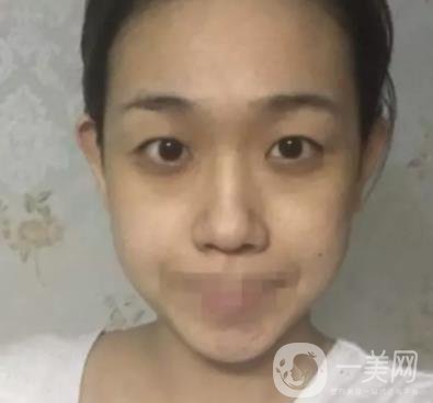 重慶醫(yī)科大學附屬第一醫(yī)院整形科價格價目表，附雙眼皮*果圖