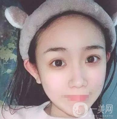 重慶醫(yī)科大學附屬第一醫(yī)院整形科價格價目表，附雙眼皮*果圖