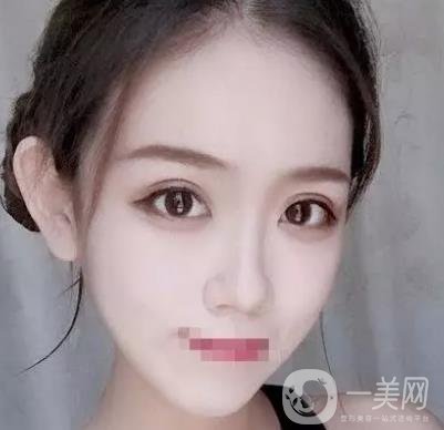 重慶醫(yī)科大學附屬第一醫(yī)院整形科價格價目表，附雙眼皮*果圖