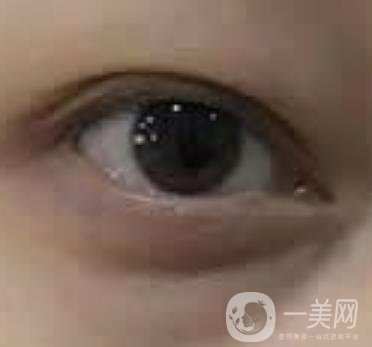 大理附屬醫(yī)院可以做去眼袋嗎?案例及整形價格表一覽