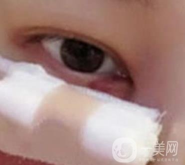 大理附屬醫(yī)院可以做去眼袋嗎?案例及整形價格表一覽