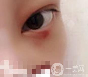 大理附屬醫(yī)院可以做去眼袋嗎?案例及整形價格表一覽