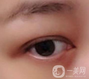 大理附屬醫(yī)院可以做去眼袋嗎?案例及整形價格表一覽