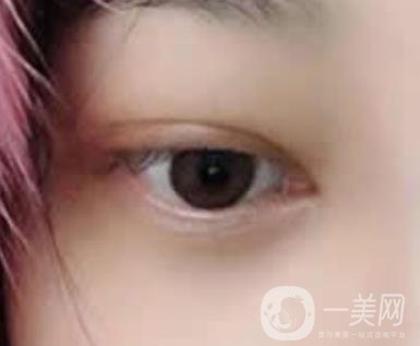 大理附屬醫(yī)院可以做去眼袋嗎?案例及整形價格表一覽