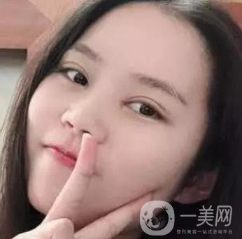 淮安第一人民醫(yī)院割雙眼皮怎樣?真人案例及整形價格表分享