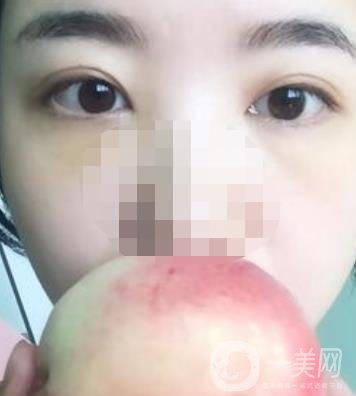 長海醫(yī)院去眼袋